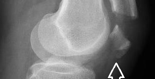 traumatologia a cura del dottor Salvi<br> LA ROTULA traumatologia a cura del dottor Salvi<br> LA ROTULA