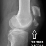 traumatologia a cura del dottor Salvi<br> LA ROTULA